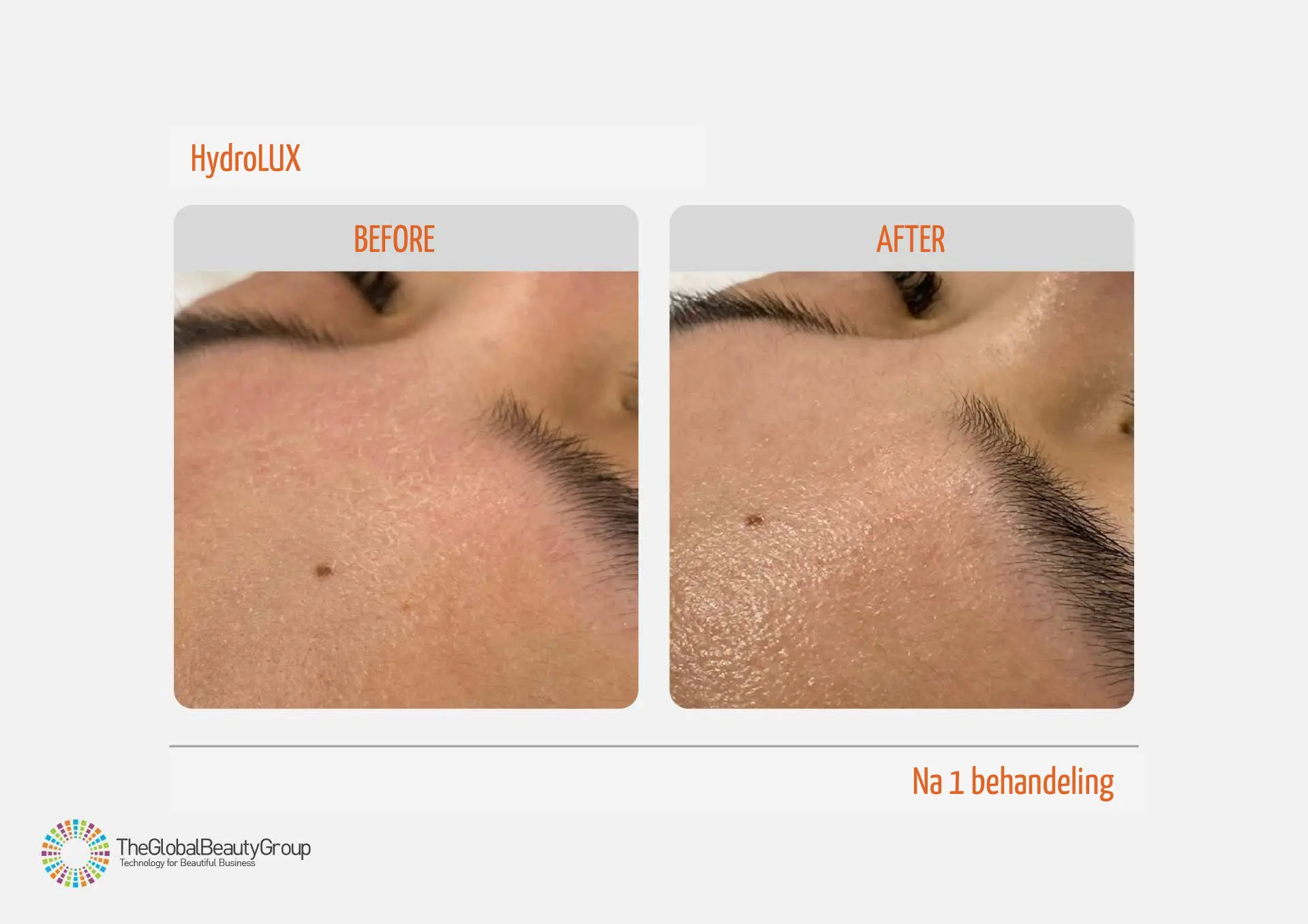Resultaat HydroLUX behandeling