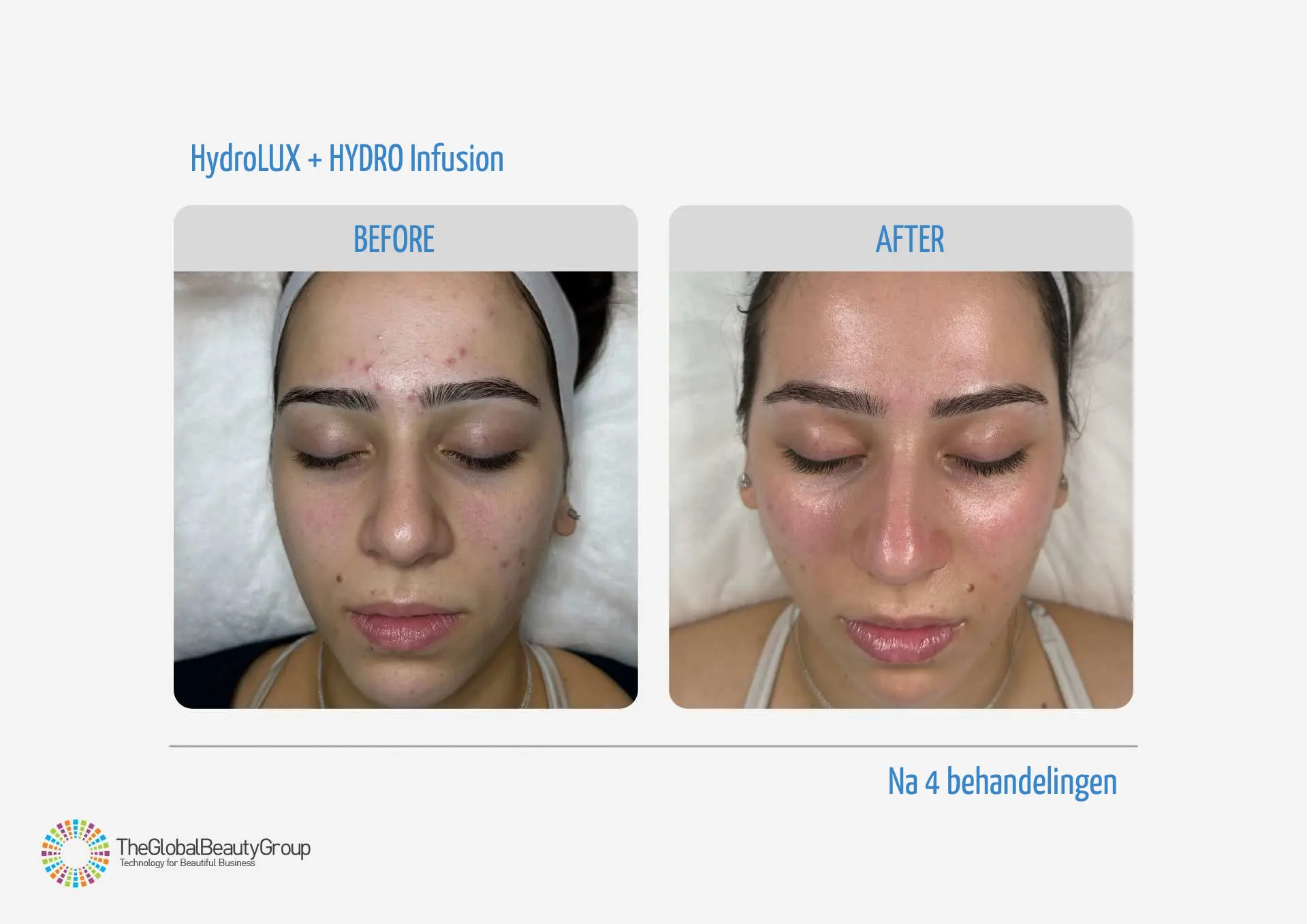 Hydradermabrasie | HydroLUX