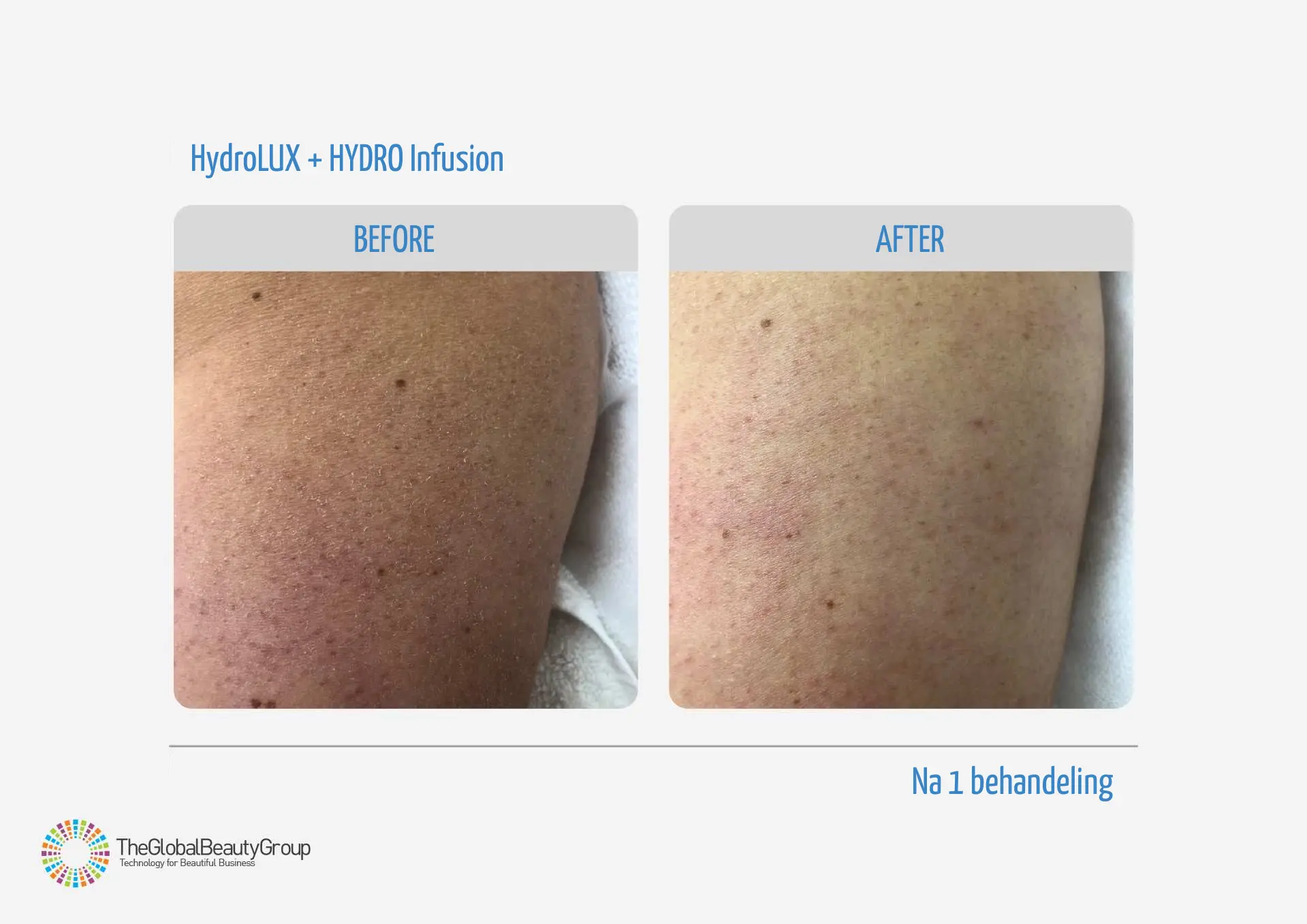 Resultaat HydroLUX behandeling met Hydro Infusion LUXCeuticals
