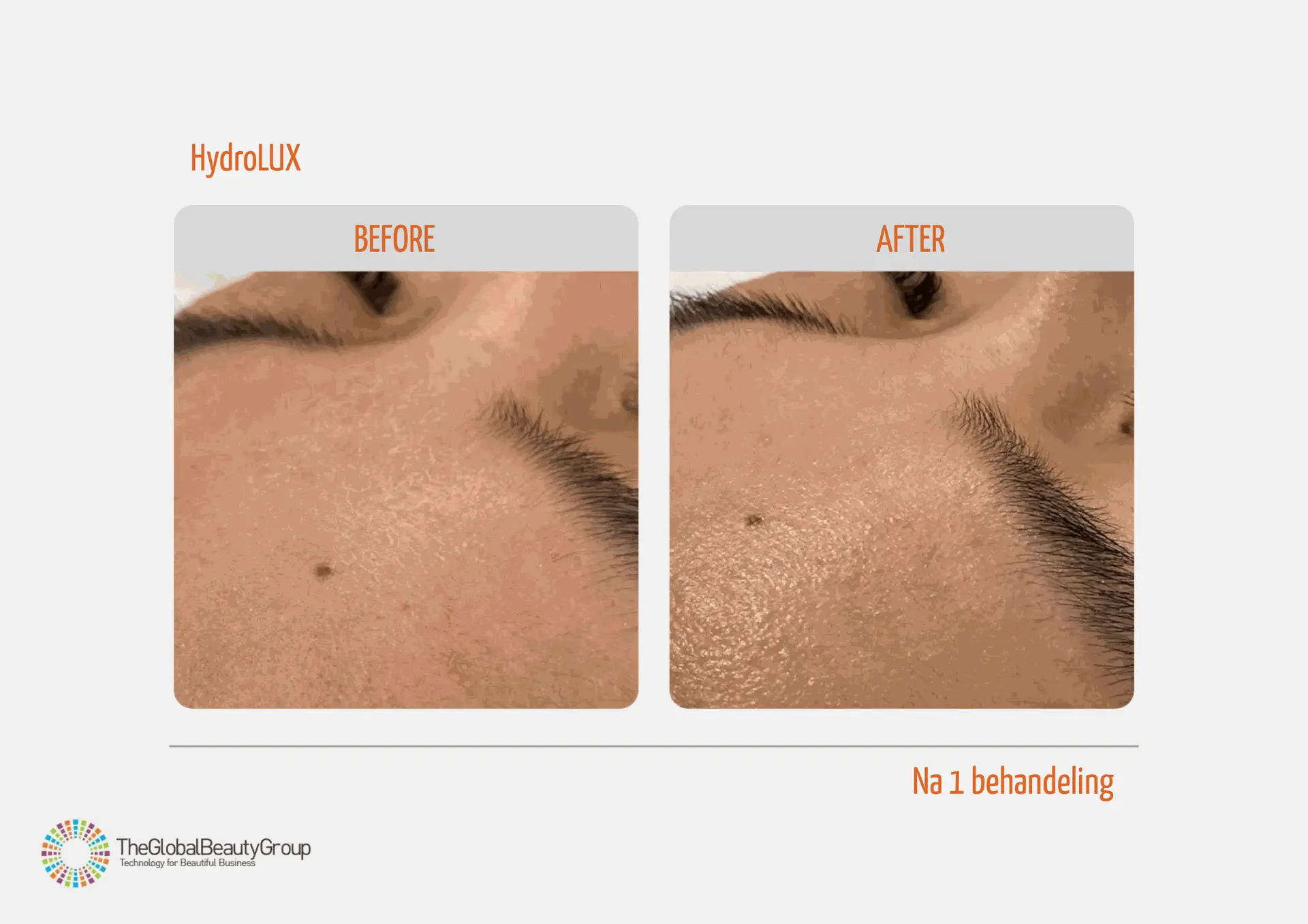 Resultaat HydroLUX behandeling