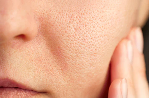 Zichtbare poriën die nood hebben aan HydroLUX behandeling